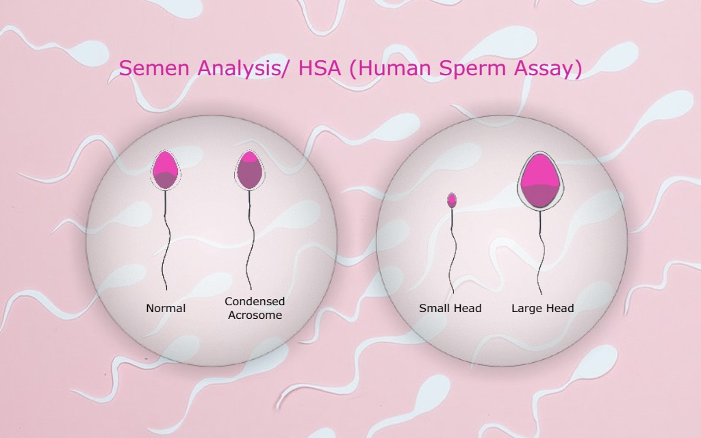 Semen Analysis - HSA (Human Sperm Assay)