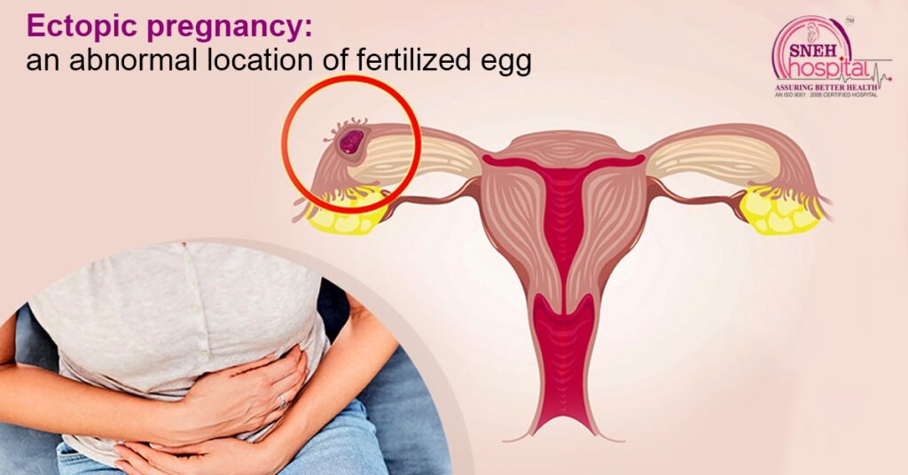 Ectopic Pregnancy: An Abnormal Location of Fertilized Egg